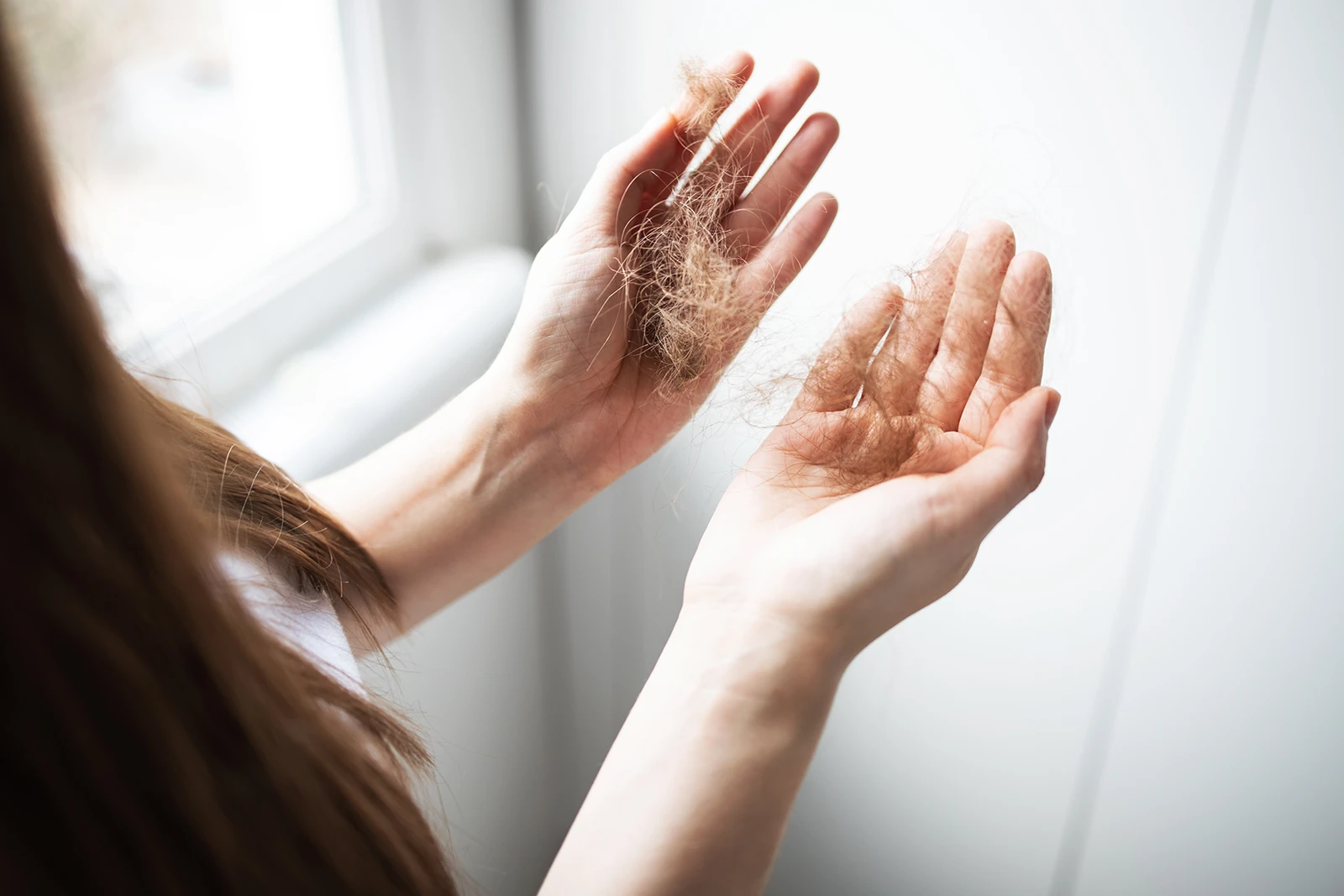Close-up of a woman's open hands holding a significant amount of fallen hair strands due to hair loss.